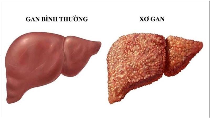 Xơ gan là tình trạng xơ hóa gan tạo thành sẹo do tổn thương trong thời gian lâu dài