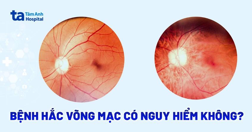 bệnh hắc võng mạc có nguy hiểm không